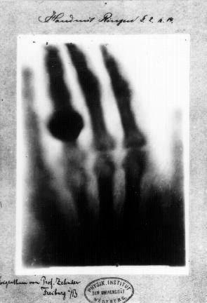 Healthcare | X-Ray of Anna Bertha Reontgen’s wedding ring 